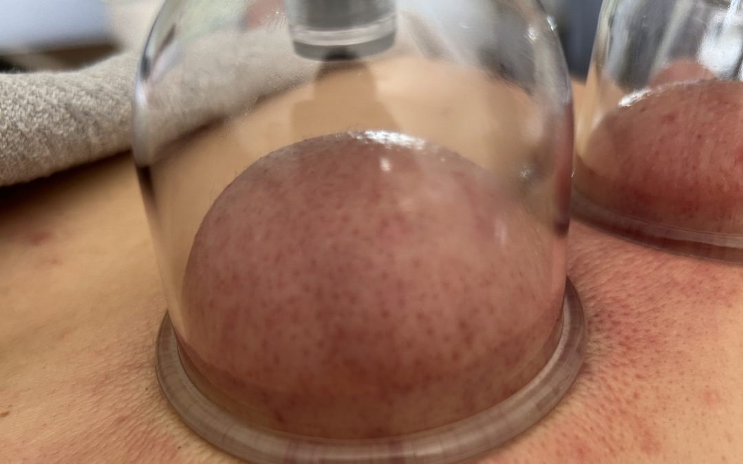 ventouses cupping douleur soulager Sarreguemines
